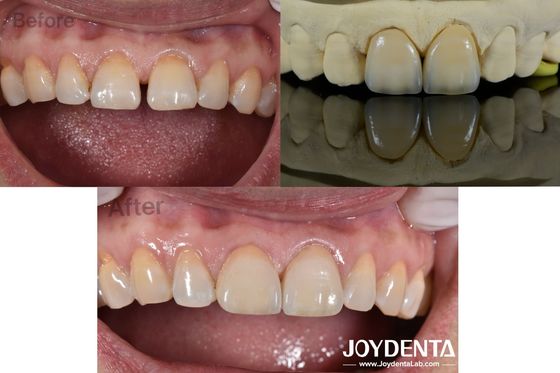 0.5mm ضخامت فنیرهای دندان سازی نفوذ پذیری کامل فنیرهای پورسلینی برای دندان های شکاف
