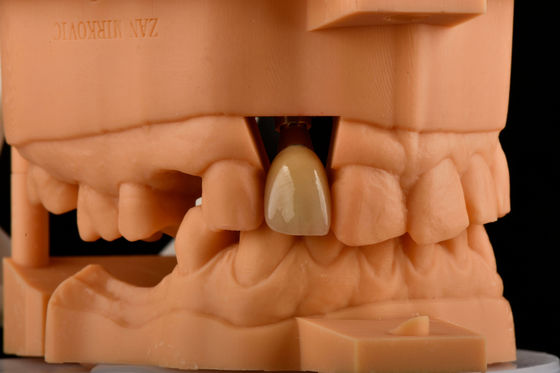 خرید Hex داخلی 3.0mm عمق 1.5mm Pitch جایگزین ایمپلنت دندان تک تیتانیوم تولید آنلاین