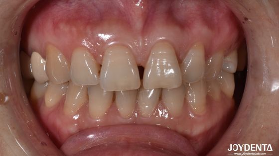 خرید 0.5mm ضخامت فلش های دندان سرامیکی طبیعی به دنبال دندان پیشانی تولید آنلاین