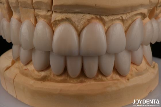 خرید 0.3mm ضخامت Ips Emax Veneers Veneers سرامیکی جلو و عقب بازسازی تولید آنلاین