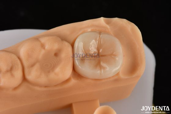خرید 0.5mm-2mm مناسب دقیق Emax دندان ساز Onlay برای بازسازی قابل اعتماد دندان تولید آنلاین
