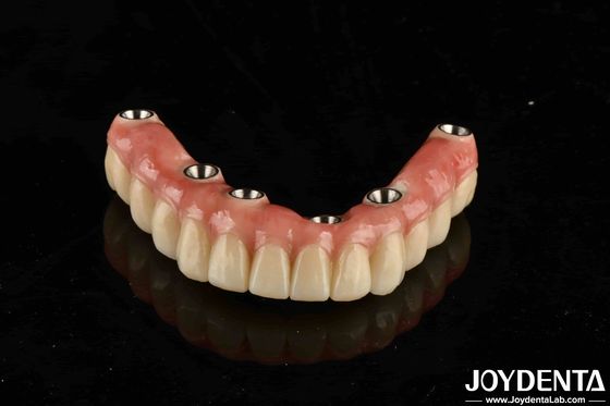 خرید پل ایمپلنت مالو تیتانیوم دندانپزشکی ترکیبی از تکنیک های سنتی و مدرن تولید آنلاین