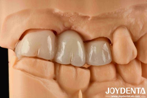 خرید تجربه رنگ واقع بینانه زرکون کامل با مقاومت بالا در برابر رنگ و مقاومت خم کردن 1000 MPa تولید آنلاین