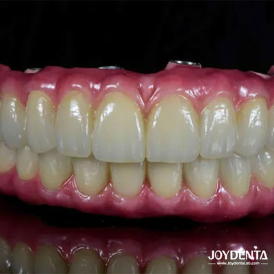 خرید پل هیبریدی تیتانیوم مالونگ برای بازسازی دندان تولید آنلاین