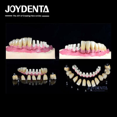 خرید ایمپلنت های متعدد دندان داخلی برای بازسازی کامل قوس تولید آنلاین