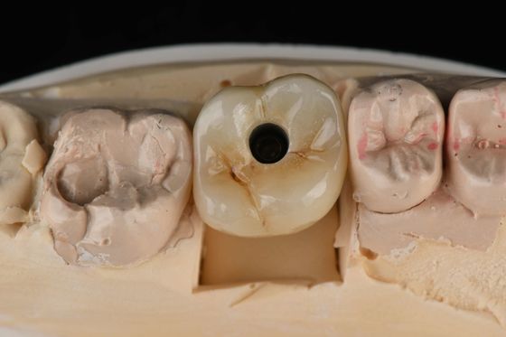 تیتانیوم 10 میلی متر تک دندان ایمپلنت های دندانی جایگزینی Abutment خود ضربه زدن شسته شده