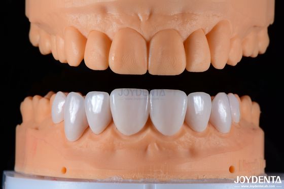 پوشه های پورسلین مناسب سرامیکی و زیبایی طبیعی با چسبندگی قوی