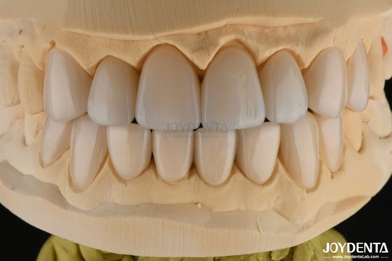 0.3-0.5mm ضخامت فلدپاتیک پورسلین فنیر مقاومت بالای شکستگی به روز رسانی لبخند خود را