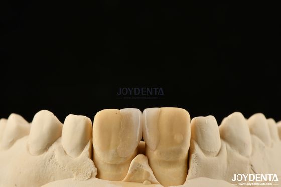 0.2mm ضخامت Microthin Veneers شیشه سرامیکی Veneers دندان برای دندان های جلو