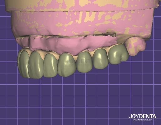 امنیت داده های سازگار با HIPAA مدل دیجیتال Wax Up 3D برای اصلاحات دندان