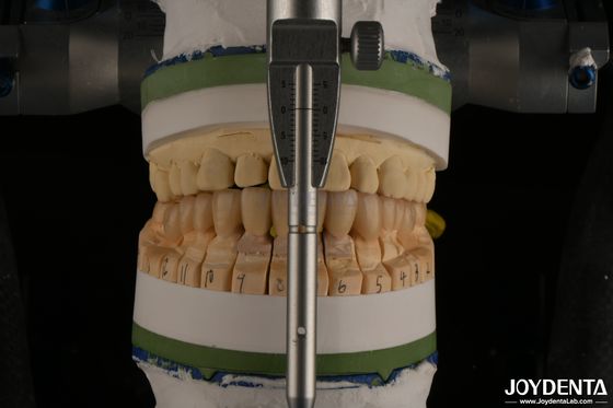 زرکونیا دندانپزشکی لایه دار چینی برای ترمیم ایمپلنت
