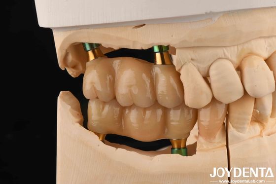 4.5mm ارتفاع پولیش شده داخلی هکس ایمپلنت دندان Abutments شکل V پیچ نگه داشته شده