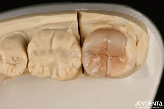 آسان تمیز کردن Emax Inlays و Onlays Hypoallergenic بیولوژیکی سازگار بازسازی دندان