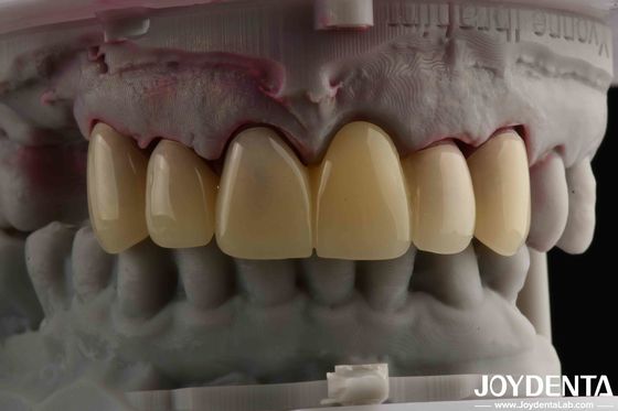 CAD CAM پردازش دندانپزشکی مواد PMMA طراحی چند لایه برای انتقال سایه طبیعی