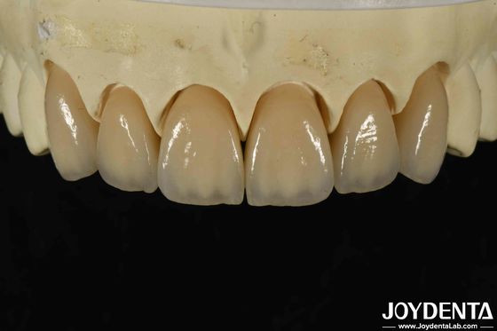 سازگاری بیولوژیکی عالی زیرکون لایه دار در زیبایی و چگالی بالا 6.0-6.1 G / cm3