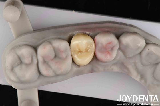 سختی شکستگی 9 MPa·m1/2 زیبایی عالی مقاومت بالا برای پوشیدن Zirconia کامل
