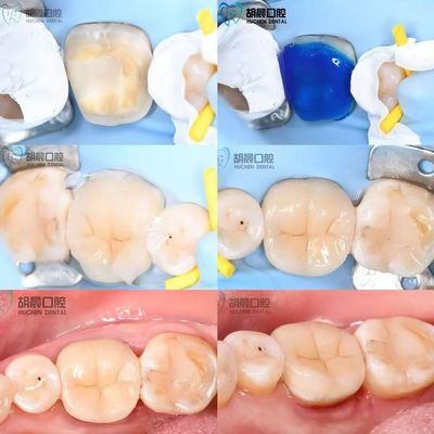 تجربه دقت تزریق دندان ارزان قیمت و سفید برای تناسب کامل