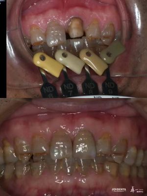 کرون های زیرکونیا شفافیت تکنولوژی تراز چند لایه ای برای شفافیت بهینه و سازگاری زیستی طولانی مدت
