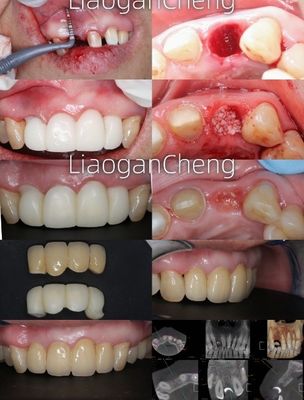تکنولوژی چند لایه ای زرکونیا دندانپزشکی ایمن و زیبایی دوستانه برای مدت طولانی