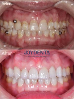 Porcelain Veneer Oral Restoration