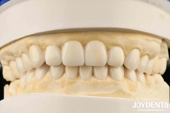 دندانپزشکی بیومیمیتیک زیبایی شناسی تشخیصی Wax-Up Of Veneers