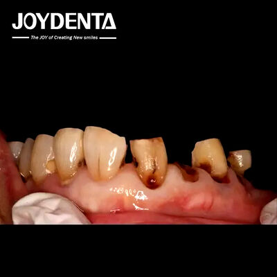 تاج زرکونیا برتر برای آزمایشگاه های دندانپزشکی جهانی