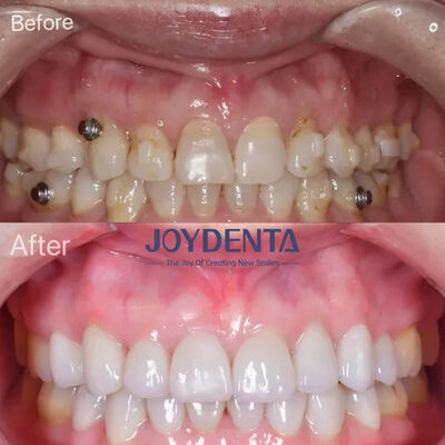 فنیرهای دندانی برای دندان های گمشده.