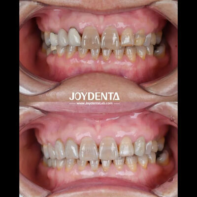 زرکونیا دندانپزشکی سبک وزن برای بهترین تجربه بیمار رنگ طبیعی