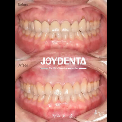 زرکونیا دندانپزشکی برای بافت دهان امن و سازگاری CAD / CAM