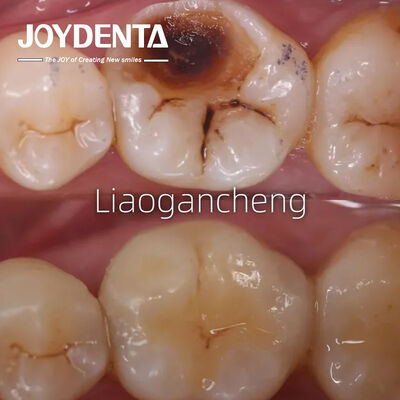 بازپروری دندان های پورسلین برای بزرگسالان و کودکان عملکرد استثنایی