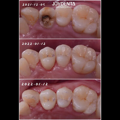 ترمیم دندان های آسیب دیده با اینلی پرسلین دندانی با تناسب دقیق